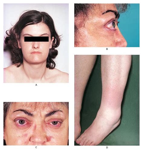 Graves Disease