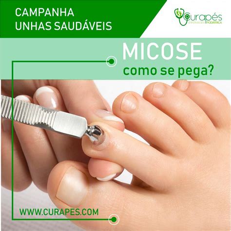 Micose de Unhas. Como se pega? a micose da unha pode ser transmitida ...