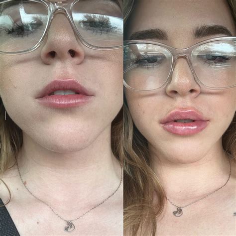Before & after 1 syringe of vesta lip filler. After swelling went down