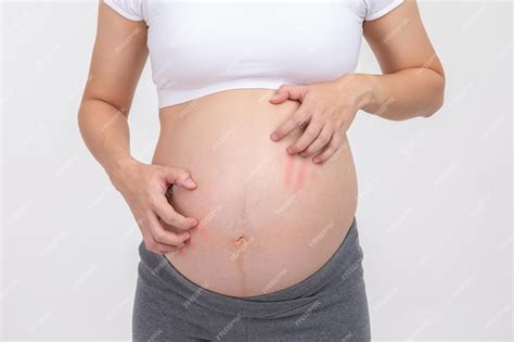 Corpo Pinicando E Coçando Na Gravidez - Mulher grávida coçando sua barriga grande coceira na pele grávida não ...