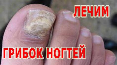 ★Как лечить ГРИБОК НОГТЕЙ на руках и ногах. Профилактика микоза ...
