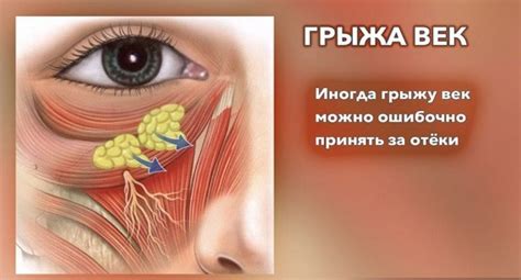 Грыжи под глазами: причины и как убрать (эффективные способы)