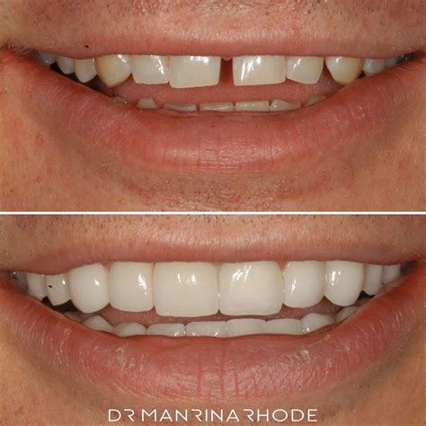 veneers london drmr  dr manrina rhode