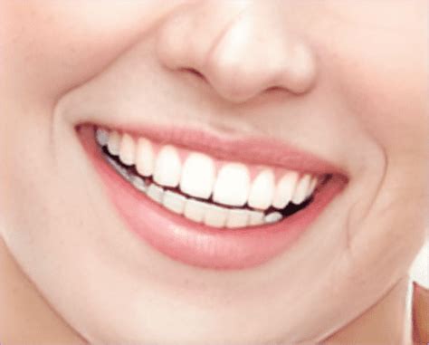 Купить Отбеливающий Корректор для Зубов Цвета V34 в Киеве — Medica+
