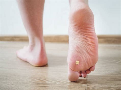 Preventive Measures & Popular Home Remedies For Foot Corn Removal - Smart Health Shop