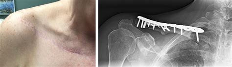 Fractura de Clavícula | Orthopaedic Trauma Association (OTA)