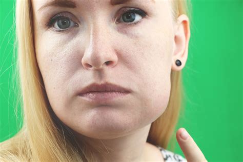Face/Cheek Swelling - Malvern East | Toorak - Victorian Dental Group
