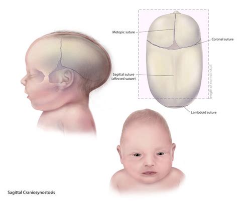 [Figure, Scaphocephaly. This image shows a...] - StatPearls - NCBI ...