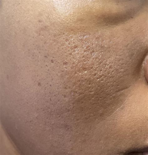 how to get rid of skin texture 6