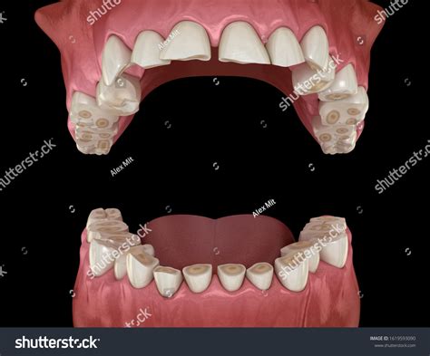 325 Attrition Tooth Images, Stock Photos & Vectors | Shutterstock