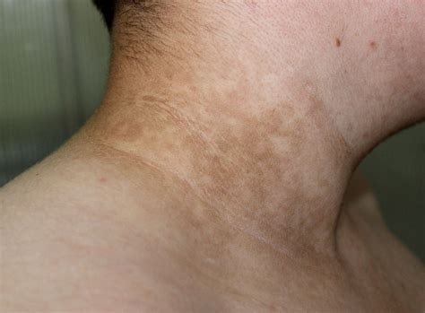 Acanthosis Nigricans