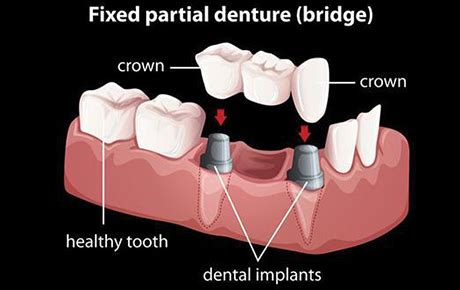 Bridges and Partial Dentures | Midtown Richmond Dentistry | Richmond, VA Dentist