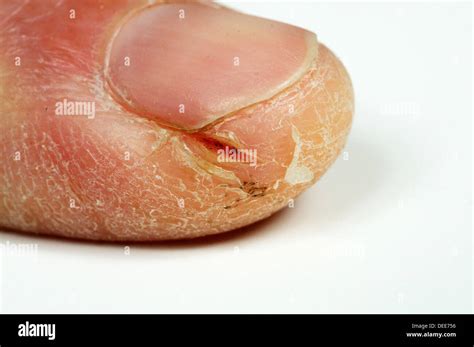 how to fix split finger nails