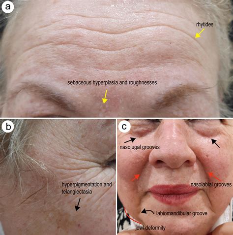 Aging Skin and Anti-aging Strategies