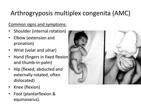 PPT - Arthrogryposis Multiplex Congenita PowerPoint Presentation - ID ...