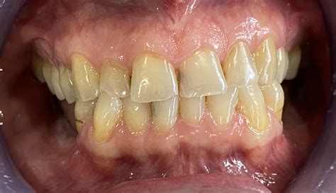 Shire Dentists - Dental Implants Major Dental Super Release