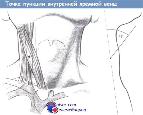 Показания и техника катетеризации центральной вены - подключичной ...