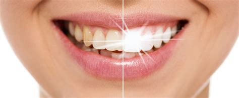 Teeth Whitening Turkey: Transform Your Smile - Turkey Teeth Blog