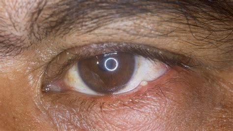 Stye inside eyelid (internal stye): How to identify, and treatments