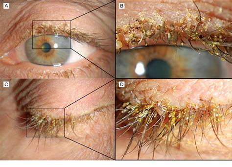 figure   case report phthiriasis palpebrarum effectively treated