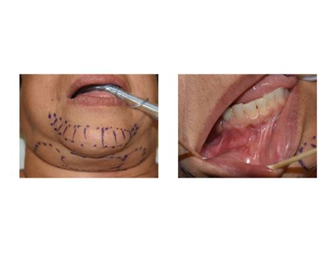 Plastic Surgery Case Study - Female Chin Implant Revision - Explore ...