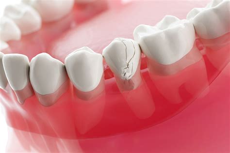 Emergency Dental Care: Tips to Manage Chipped & Cracked Teeth | Encino ...