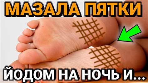 Мало Кто ЗНАЕТ, Что Творит Сетка из ЙОДА на пятках, даже после двух раз ...