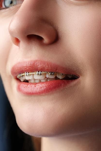 page   braces pictures