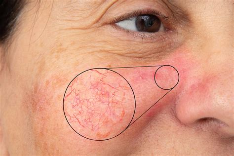 capillary on face 7
