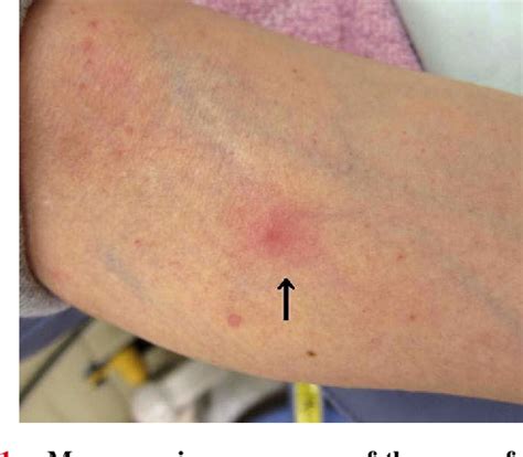 Figure 2 from Disseminated gonococcal infection in an elderly Japanese ...