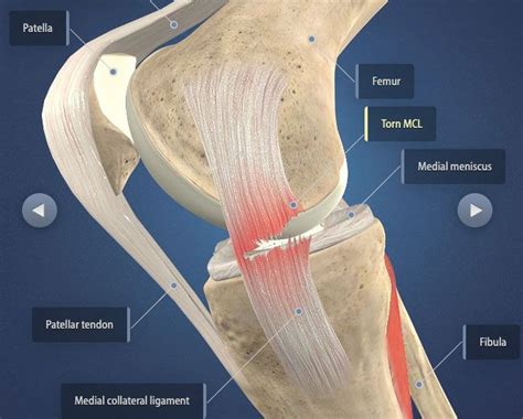 how long does it take to heal a torn mcl