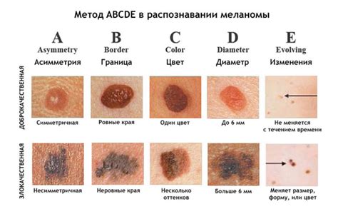 Рак кожи - базалиома, плоскоклеточная карцинома, меланома: симптомы ...