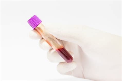 Пролактин (Prolactin)