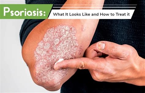 Decoding Psoriasis: Understanding its Underlying Causes - Expotab.me