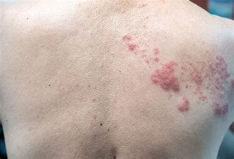 What Does a Shingles Rash Look Like at First? - Okkii.com