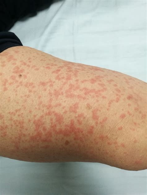 Alergija na penicilin: Jedna od najčešće prijavljenih alergija na ...