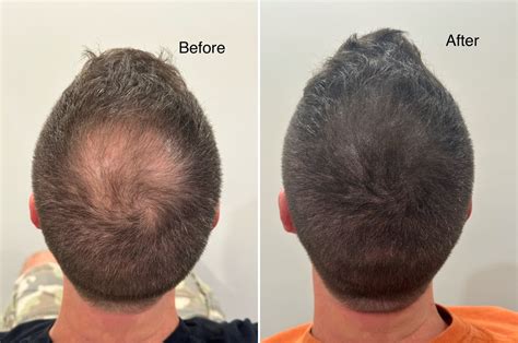 Scalp Micropigmentation photos | Miami, FL | Patient125572