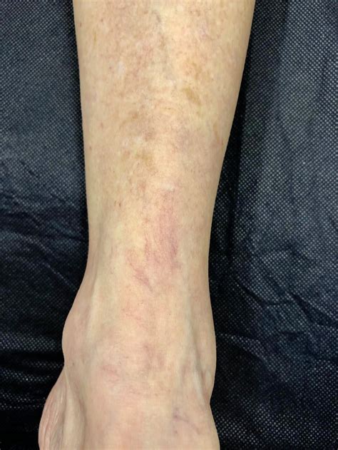 Spider Vein Treatment Brisbane Results — The Leg Vein Doctor | Brisbane