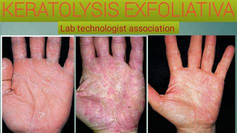 Pitted Keratolysis Minor at Edward Dixon blog