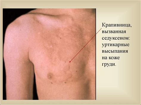 Аллергические заболевания. Другие аллергические (не атопические ...