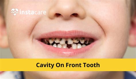 What Causes Cavity On Front Tooth?