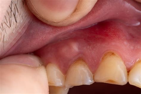 Doylestown Dental Abscess & Infection | 24/7 Emergency Care