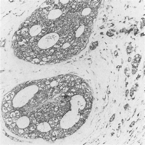 In situ and infiltrating carcinoma ofthe brcast informalinfixed ...