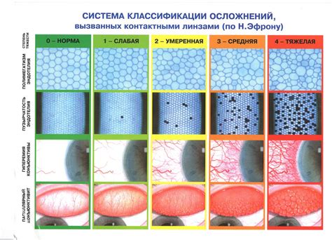 Лещенко И А Практическое Руководство По Подбору Мягких Контактных Линз ...