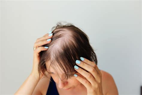 O Que Significa Calva - Mulher Calva: O que pode ser? Conheça as causas da calvície feminina ...
