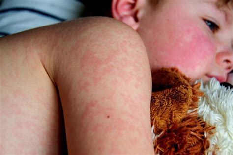 Infecção De Pele Infantil Fotos - Infecção na pele: 16 tipos (e o que fazer) - Tua Saúde