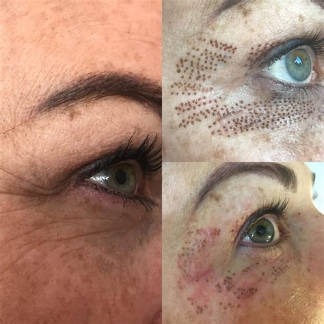 What Is Plasma Treatment For Face