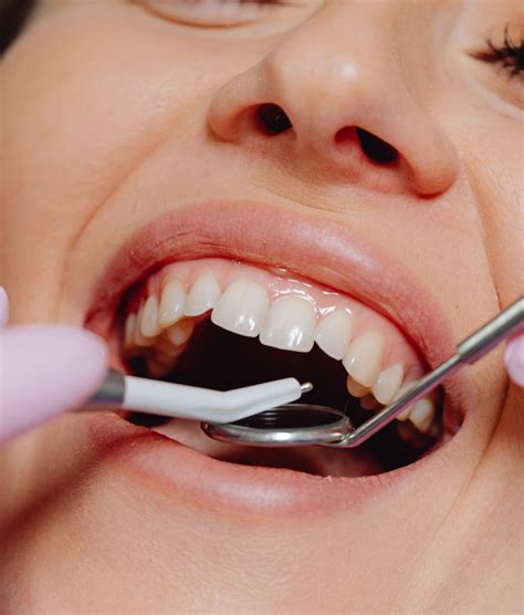 Gum Treatment - Shape Dental