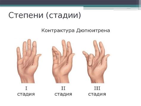 КОНТРАКТУРА ДЮПЮИТРЕНА. ЛЕЧЕНИЕ КОЛЛАГЕНАЗОЙ. Работу выполнили: Гизатулин