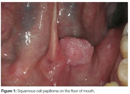 Hpv Tongue Lesions
